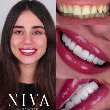 Slider image (5) Best Dental Clinic in Istanbul - Niva Aesthetic